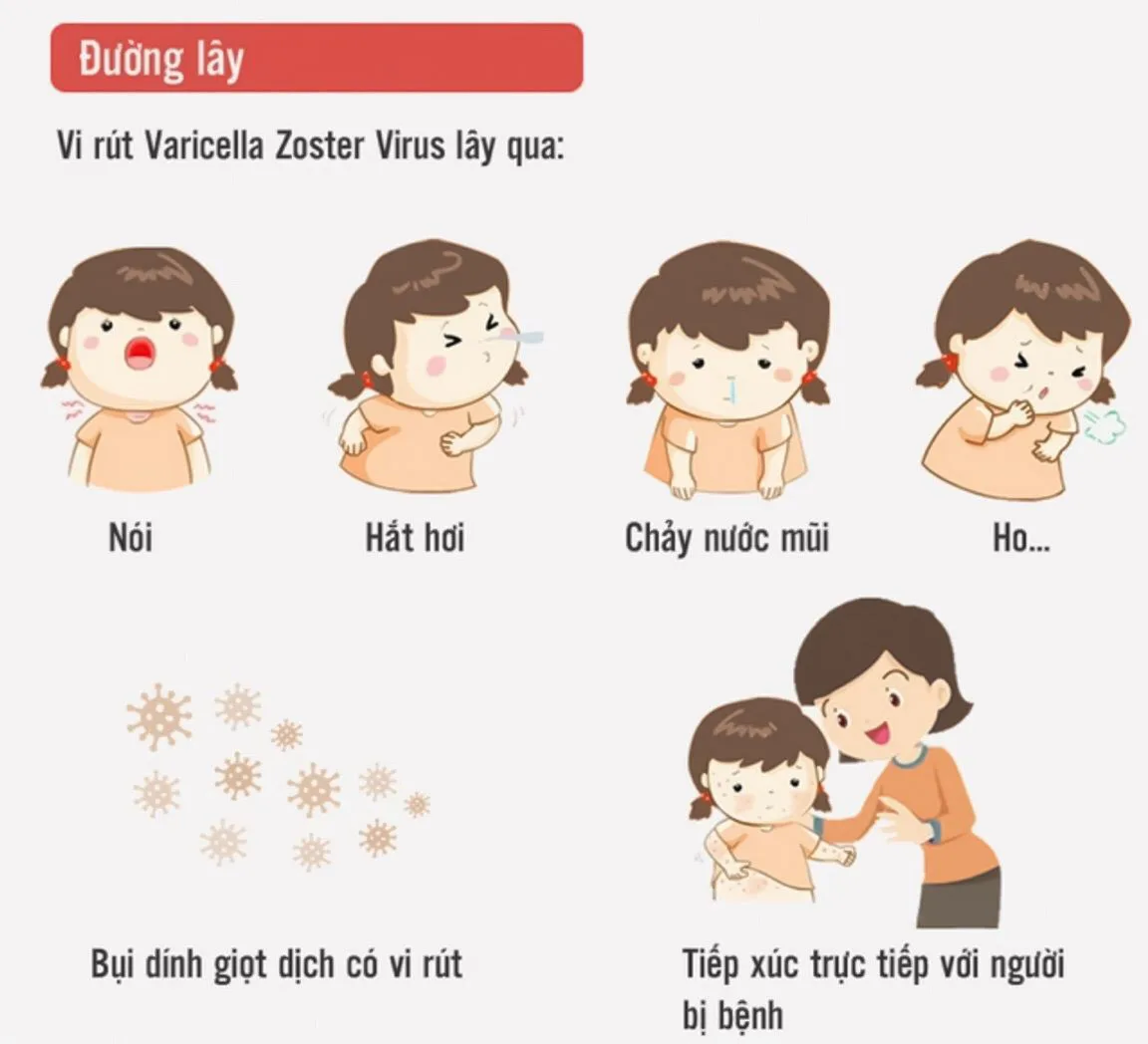 Cảnh báo! Dịch thuỷ đậu đang vào mùa & những điều cần biết Cảnh báo! Dịch thuỷ đậu đang vào mùa & những điều cần biết