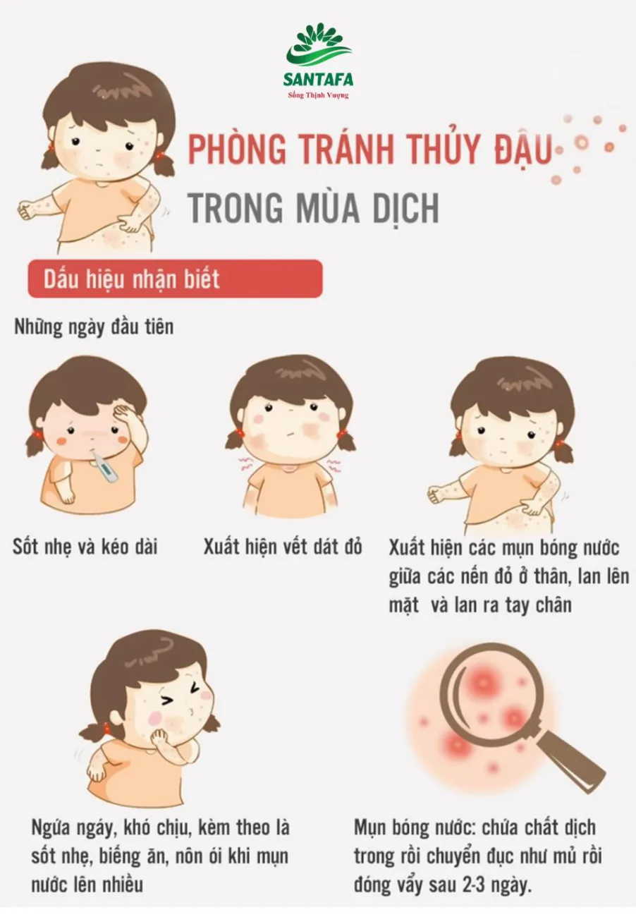 Cảnh báo! Dịch thuỷ đậu đang vào mùa & những điều cần biết thuỷ đậu2