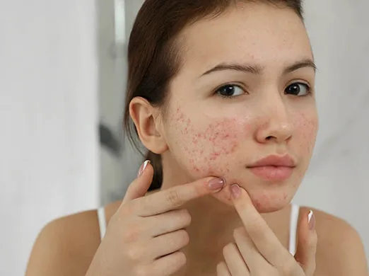 Quy trình 4 bước chăm sóc da mụn đúng cách và hiệu quả da mụn3