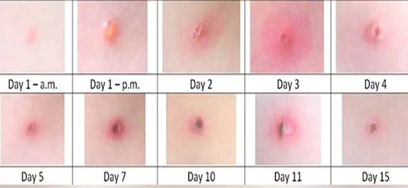 Cảnh báo! Dịch thuỷ đậu đang vào mùa & những điều cần biết thuỷ đậu1