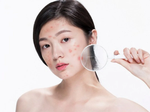 Quy trình 4 bước chăm sóc da mụn đúng cách và hiệu quả da mụn2