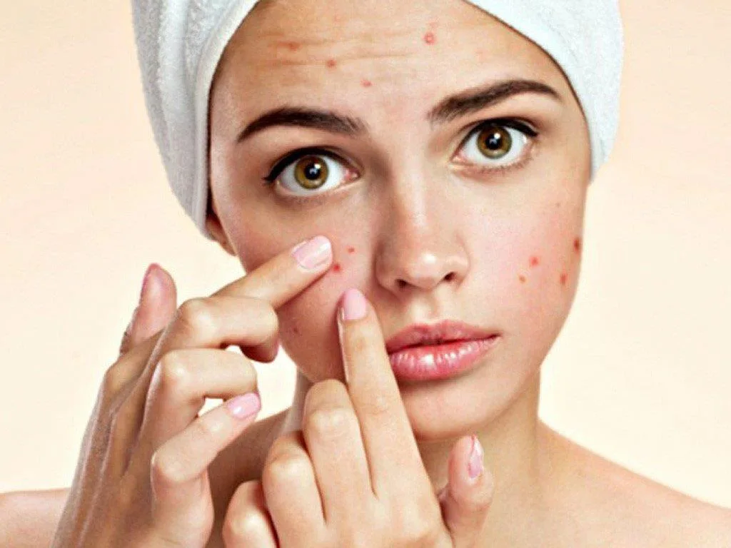 Quy trình 4 bước chăm sóc da mụn đúng cách và hiệu quả da mụn1