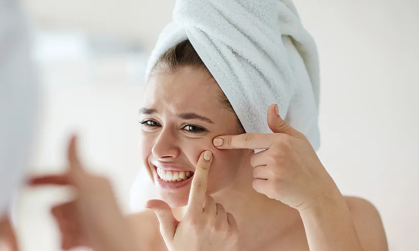 Những điều cần đặc biệt lưu ý khi chăm sóc da đang bị mụn và sau khi hết mụn