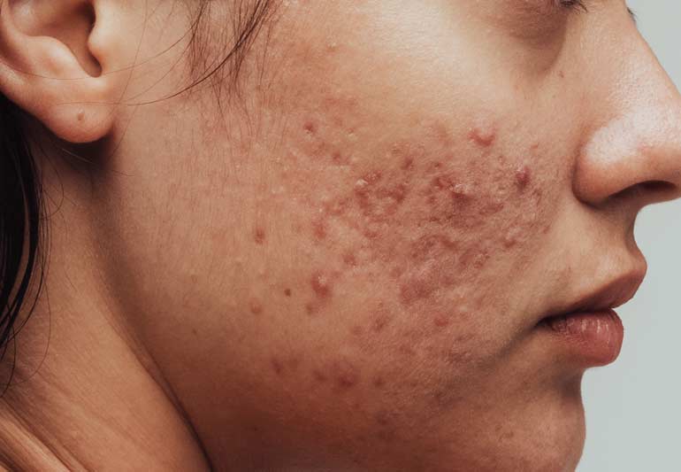 Sữa rửa mặt Acnevir – Sữa rửa mặt cho da mụn đáng thử nhất Sữa rửa mặt Acnevir – Sữa rửa mặt cho da mụn đáng thử nhất