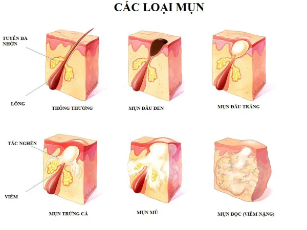 Cac-loai-mun-lung