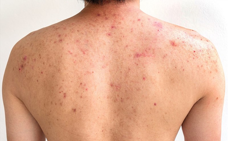 Top 5 phương pháp trị mụn lưng hiệu quả tại nhà dieu-tri-mun-lung