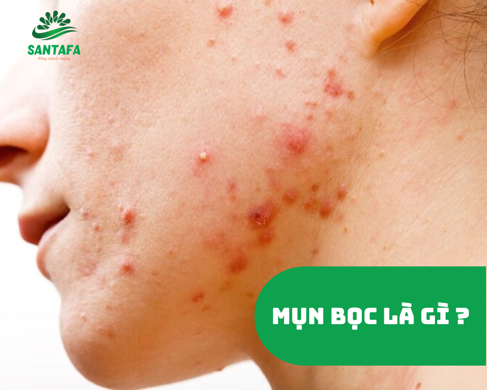 Xử lý mụn bọc hiệu quả tiết kiệm cho học sinh sinh viên