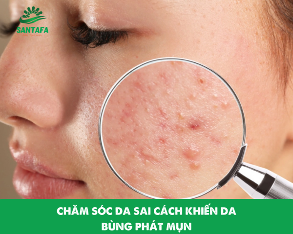 Xử lý mụn bọc hiệu quả tiết kiệm cho học sinh sinh viên